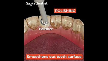 Teeth Cleaning Removes Stains And Yellow Color Tartar 