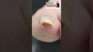 깊게 박힌 발톱!!?? #shorts #내성발톱 #무좀발톱 #무좀관리 #ingrown #toenails