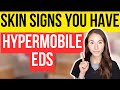 Unlocking the secrets 12 surprising skin signs of hypermobile ehlersdanlos syndrome