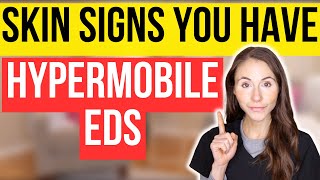 Unlocking The Secrets: 12 Surprising Skin Signs Of Hypermobile Ehlers-Danlos Syndrome