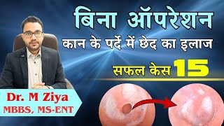 1साल पुराना पर्दे का छेद. बिना ऑपरेशन, इलाज द्वारा भर गया. New Tech Patch plasty # 15