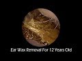 Compilation Of Ear Wax Removal For 12 Years Old