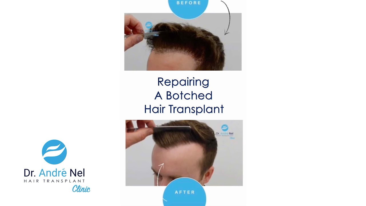 Repairing A Botched Hair Transplant | Dr. André Nel Hair Transplant Clinic