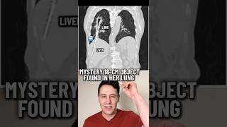 Solve the mystery of how a 18 cm metal object ended up sitting in this woman’s lung for 30 years?