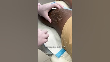 PRP Therapy for Knee Pain 🦵