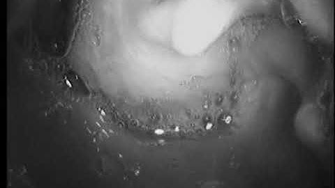 p.272. Glidescope Intubation Sequence