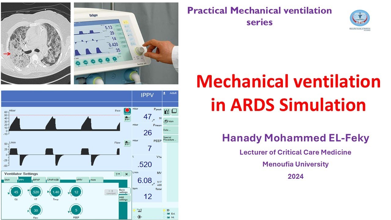 Machine For Ards Rotation Simulation of Ventilator settings in ARDS in Arabic - YouTube