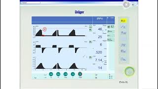 Ventilator settings in ARDS (Simulation) in Arabic