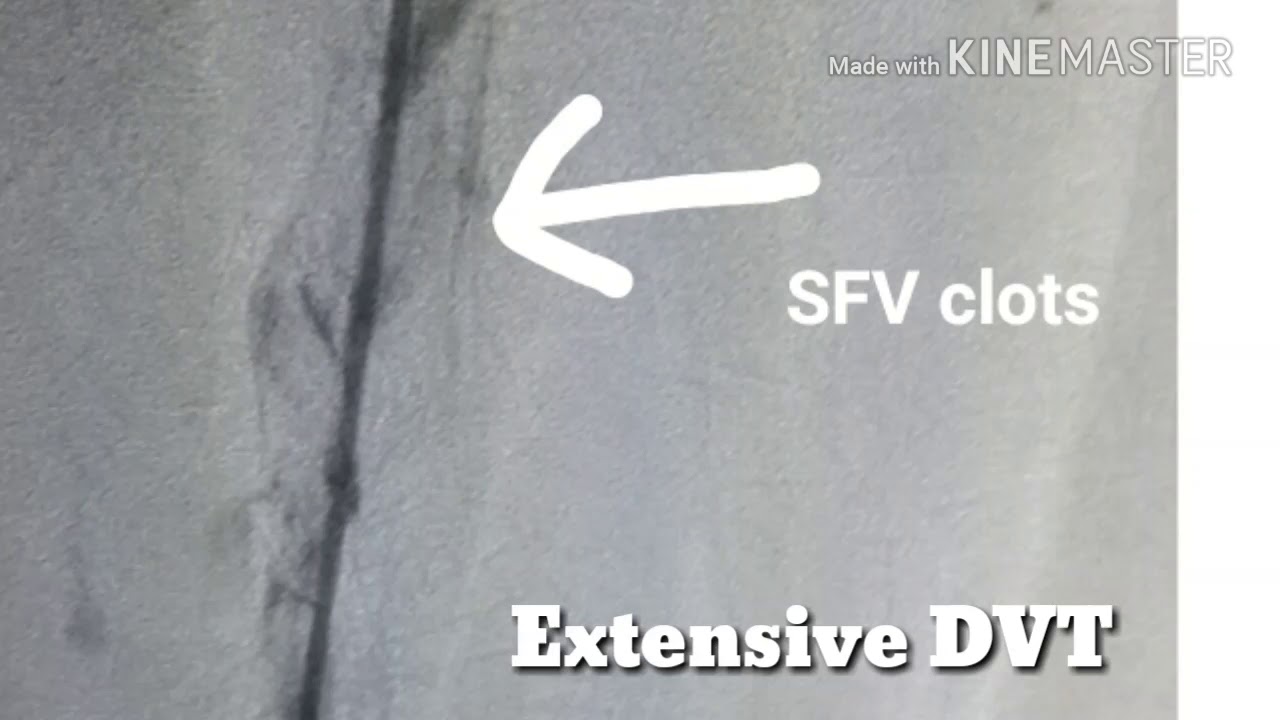 vascular speciality Dr Shaileshkumar Garge catheter directed