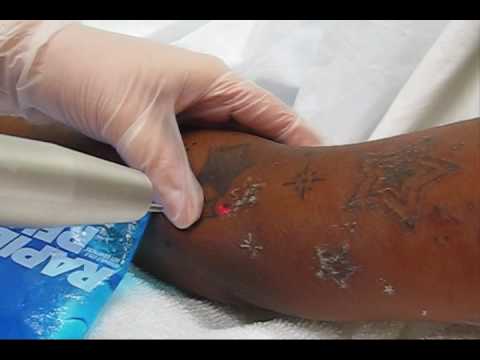 Laser Tattoo Removal - YouTube