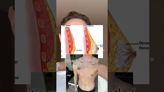 If You Have Questions About Gynecomastia, Leave A Comment And I Will Respond