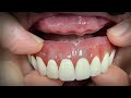 Finalizing a Highly Esthetic Denture with Dentist & Patient In-Lab