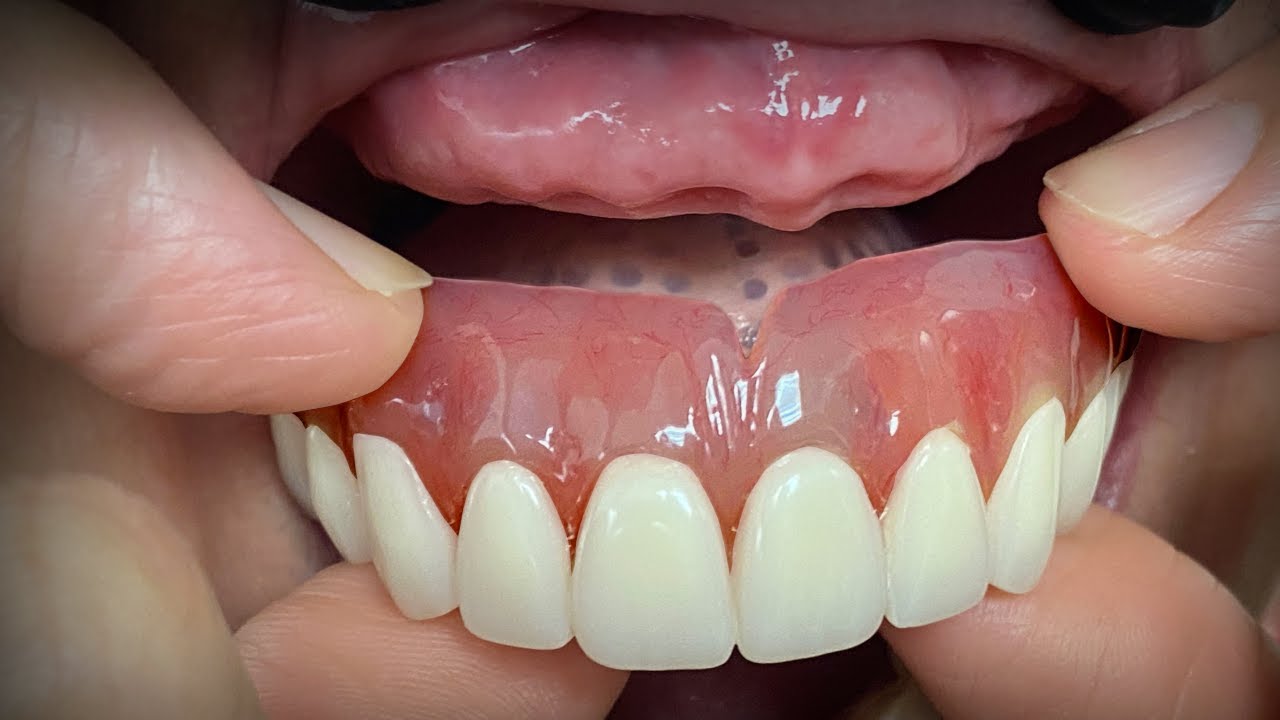 Finalizing a Highly Esthetic Denture with Dentist & Patient InLab YouTube