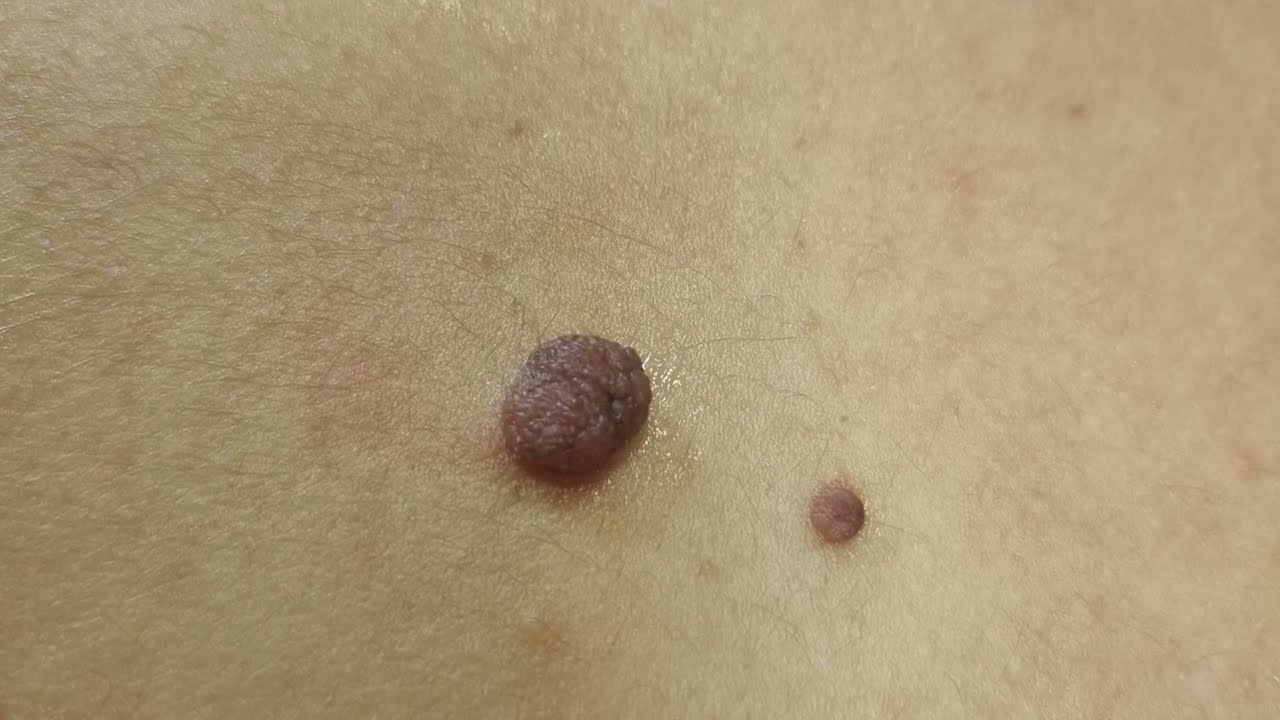 Verheven plekjes coaguleren | Zapper | Huid,- oedeem en laserkliniek Epilennium Maassluis