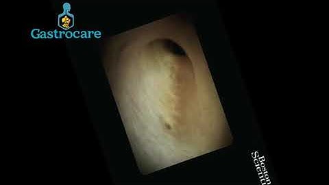 CPRE MAS SPYGLASS MAS TOMA DE BIOPSIA