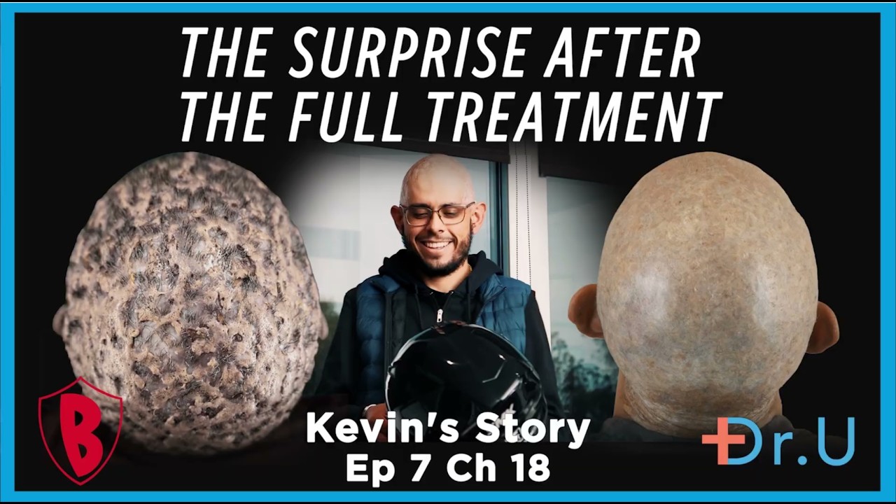 Painful Scalp Lumps and Hair Loss: His Transformation After Surgery