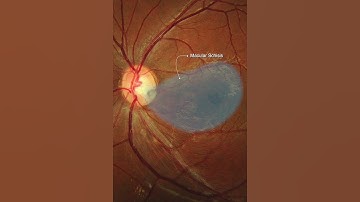 Optic disc pit maculopathy