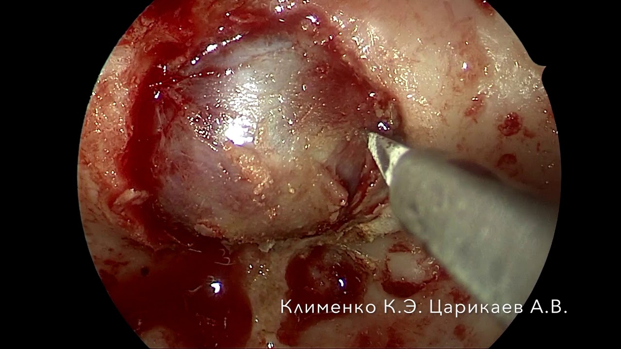 Краниофарингиома