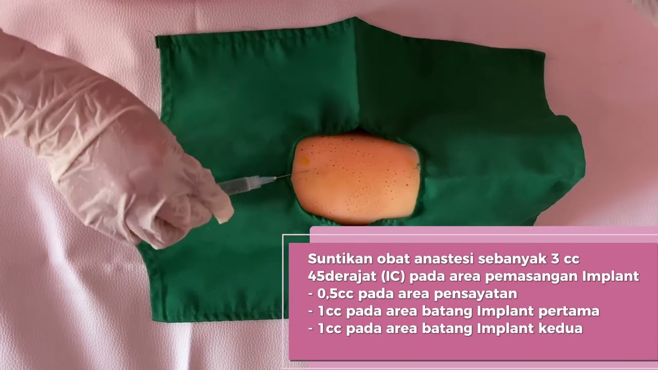 AKBK KB IMPLANT oleh Sabillaagussaputri 