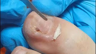 A piece of nail like sawtooth was removed. Fungal nail treatment &amp; ingrown toenails removal.