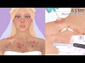 Satisfying! chest acne blackhead removal | animation | pimples skin care | bridal spa