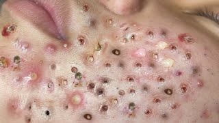 Loan Nguyen Acne Treatment 54b