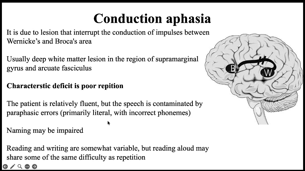 Disconnection syndromes د علاء مشعل