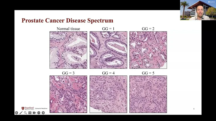 AIMI Grand Rounds: The Opportunity for AI to Improve Prostate Cancer Detection and Treatment
