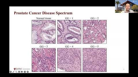 AIMI Grand Rounds: The Opportunity for AI to Improve Prostate Cancer Detection and Treatment