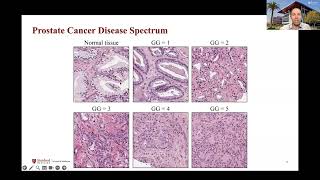 AIMI Grand Rounds: The Opportunity for AI to Improve Prostate Cancer Detection and Treatment