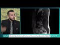 مقابلة الدكتور أشرف المقداد للحديث عن مرض الديسك أو الانزلاق الغضروفي على الاخبارية السورية