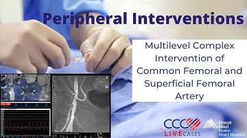Multilevel Complex Intervention of Common Femoral and Superficial Femoral Artery