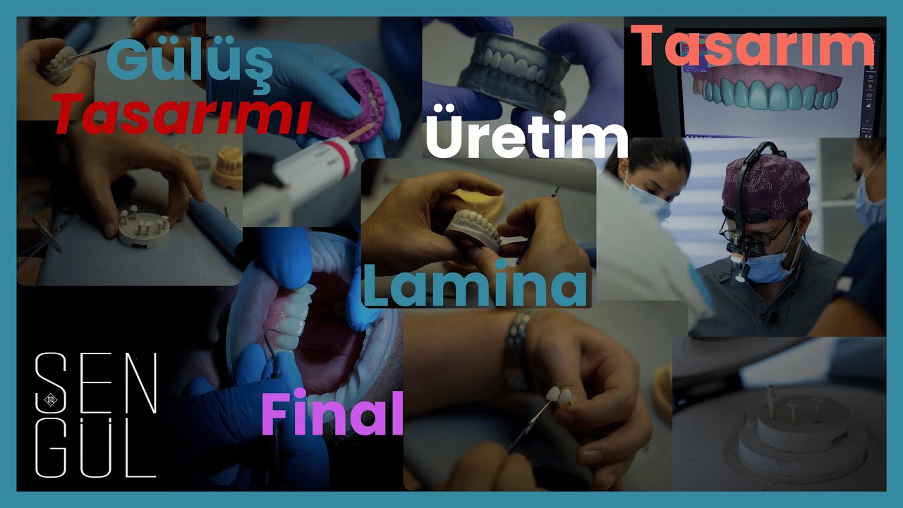 Gülüş Tasarımı Nasıl Yapılır? Tasarım, Üretim, Lamina ve Final | Mini Belgesel