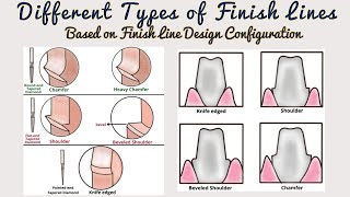 Types of Finish Lines based on Design/ Finish Lines in Fixed Partial Denture/ Tooth Preparation