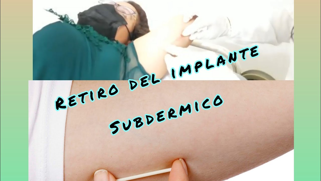 Retiro del implante subdermico y mi experiencia 🩹con el implante 🤭
