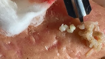 Make your Acne Treatment Huong Da Nang | 448# Hoang Part 2 | acne 2022