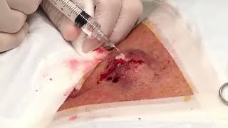 Speedy Back Cyst! Dr. Gilmore's Worst Extractions
