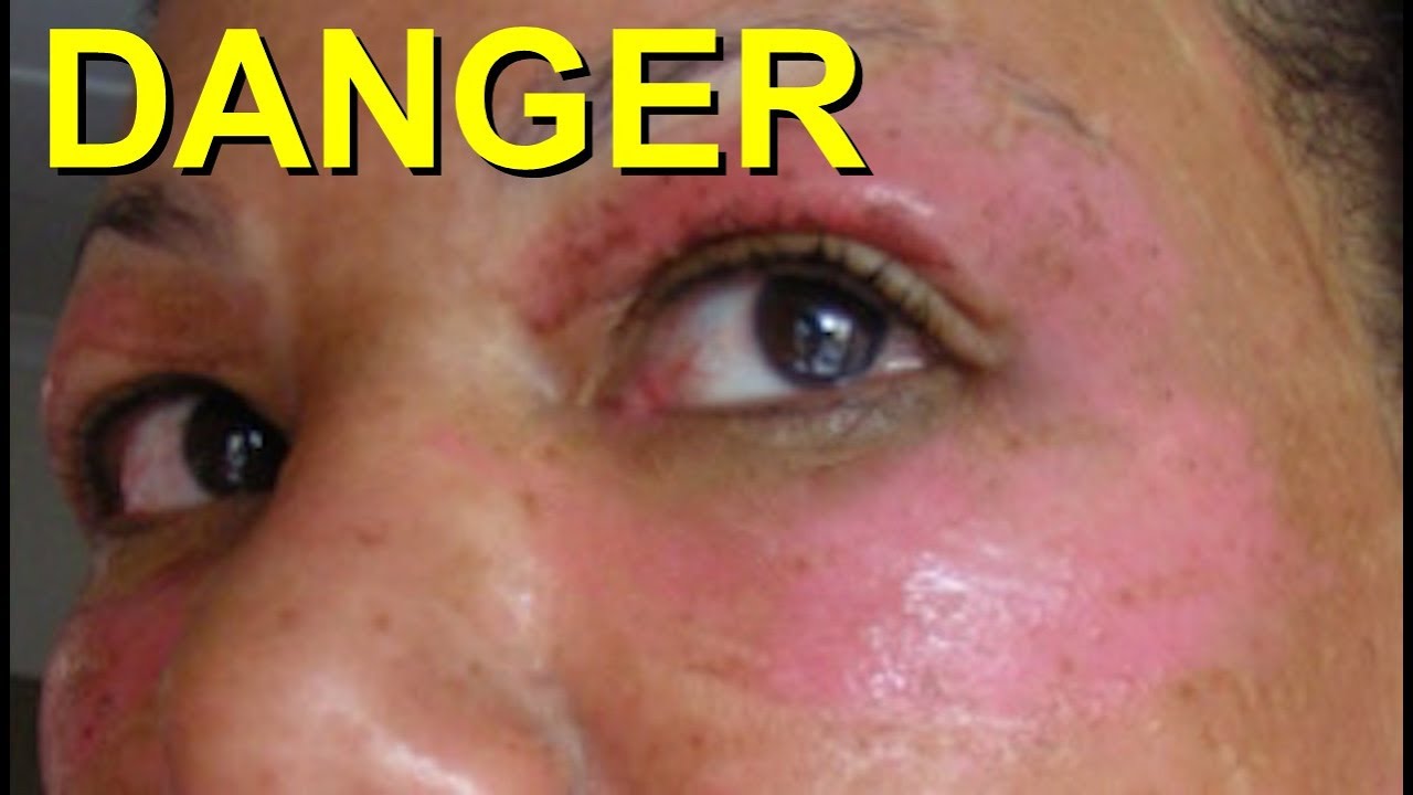 UNDER EYE DAMAGE after LASER/CHEMICAL Peels. How to Prevent DARK