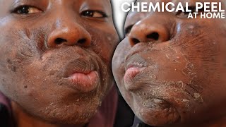 CHEMICAL PEEL FULL PROCESS AT HOME USING JESSNER&#39;S PEEL | BEFORE &amp; AFTER