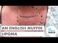 An English Muffin Lipoma