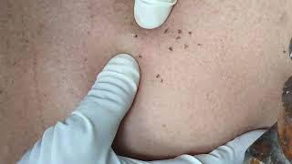 Back Hole Blackheads Removal