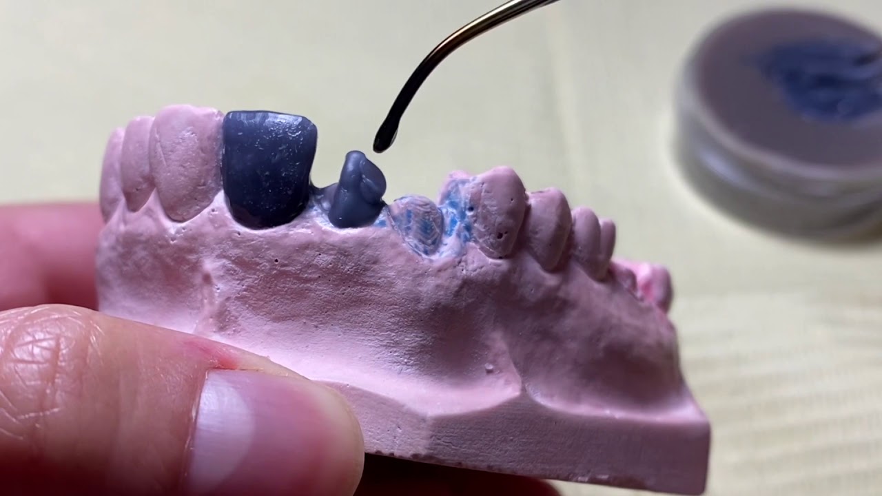 Encerado dientes anteriores