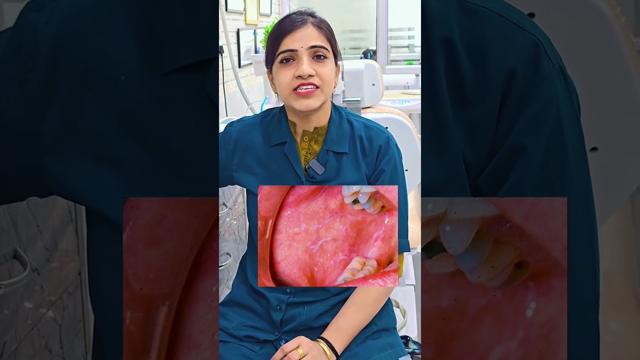 Oral wickhiam striae | diagnostic tool of oral lichen planus 