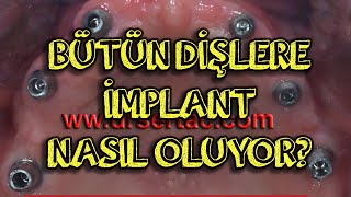 Bütün dişlere implant nasıl olur? Hiç diş olmayan ağızda implant uygulanması hakkında bilgilendirme.