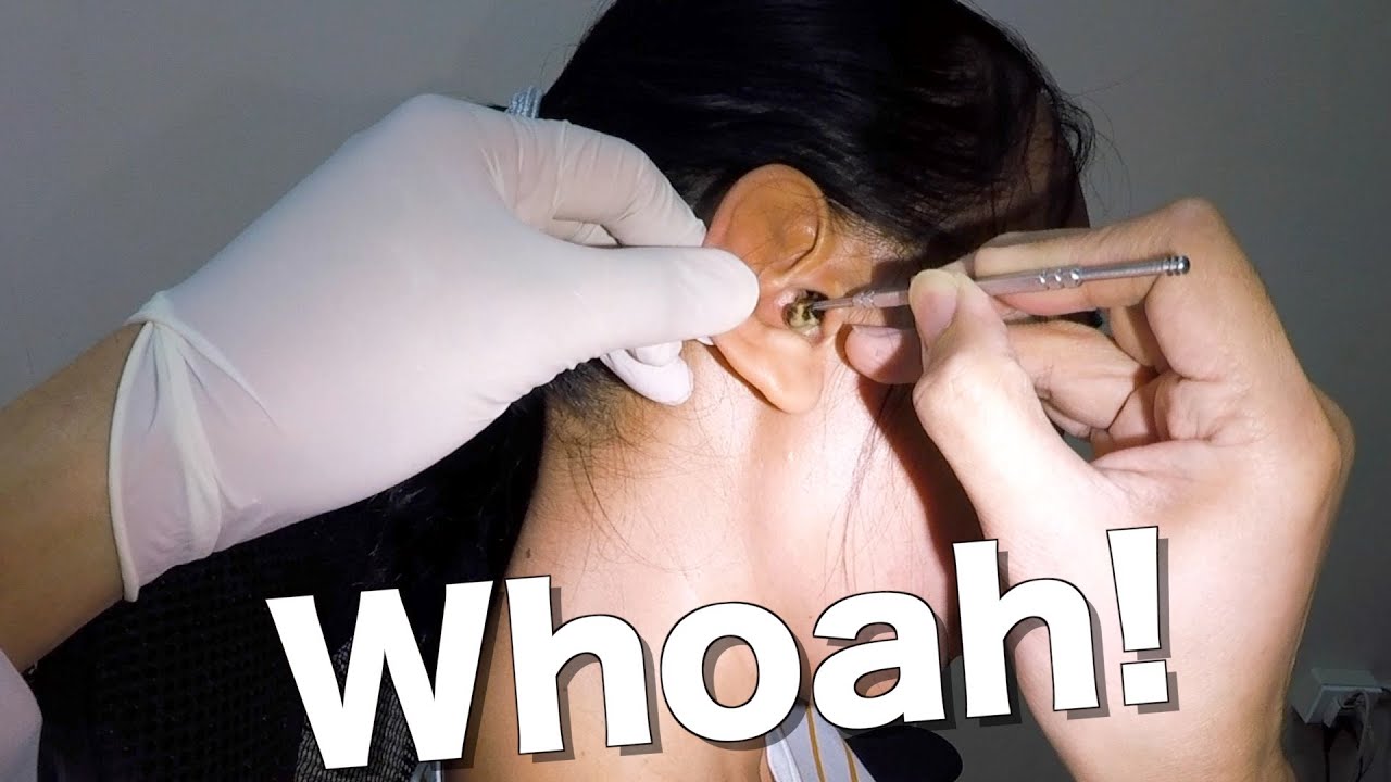 Huge Earwax Removed From Woman's Ear It's A Gold Mine! YouTube