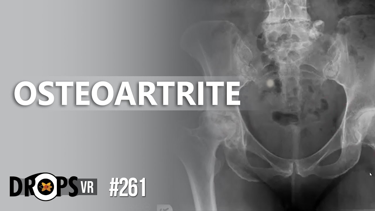 OSTEOARTRITE - COMO CARACTERIZAR?