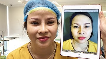 Cải Thiện Đôi Mắt Sụp Mí Nhanh Chóng Bằng Cắt Mí Mani Mini Deep 5D.