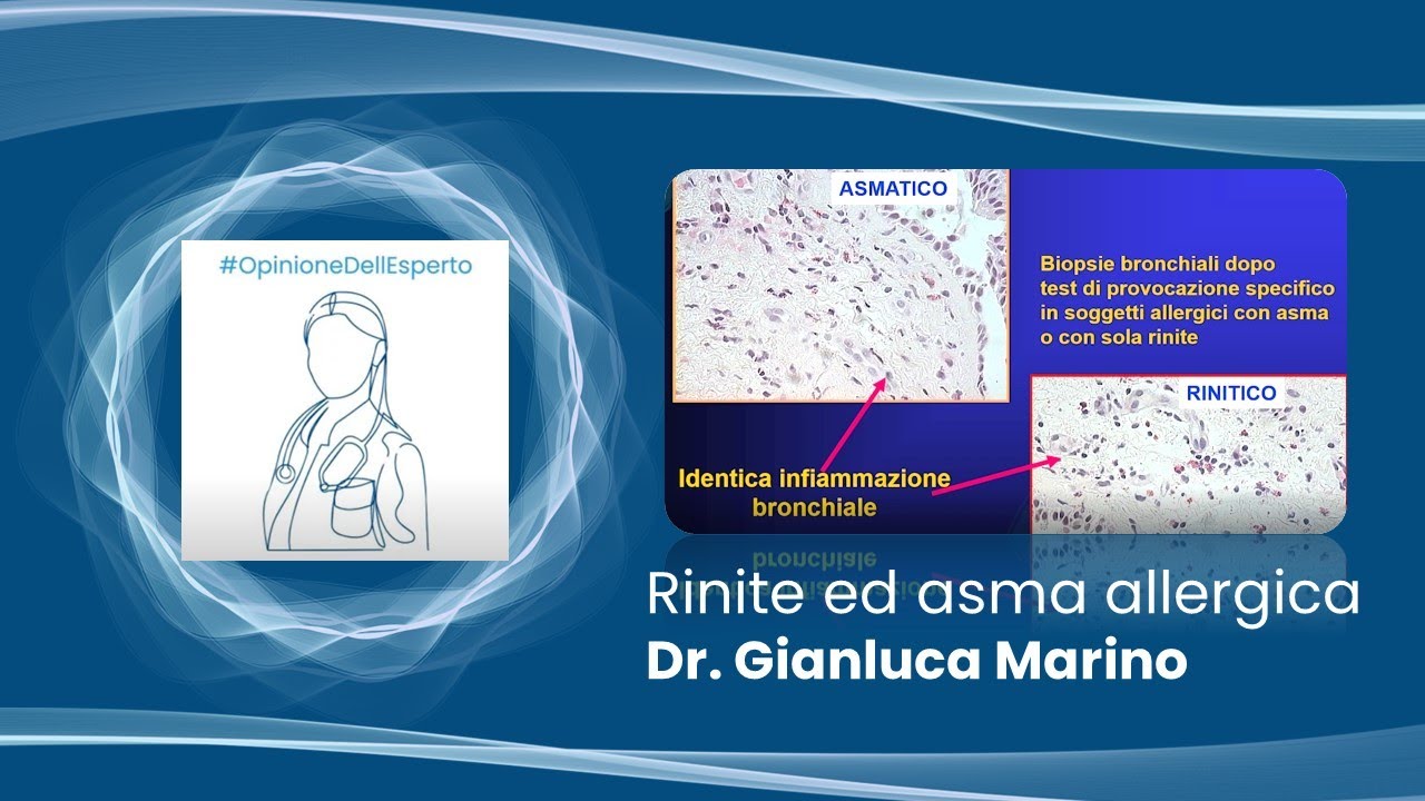 Rinite ed asma allergica - Dr.Gianluca Marino