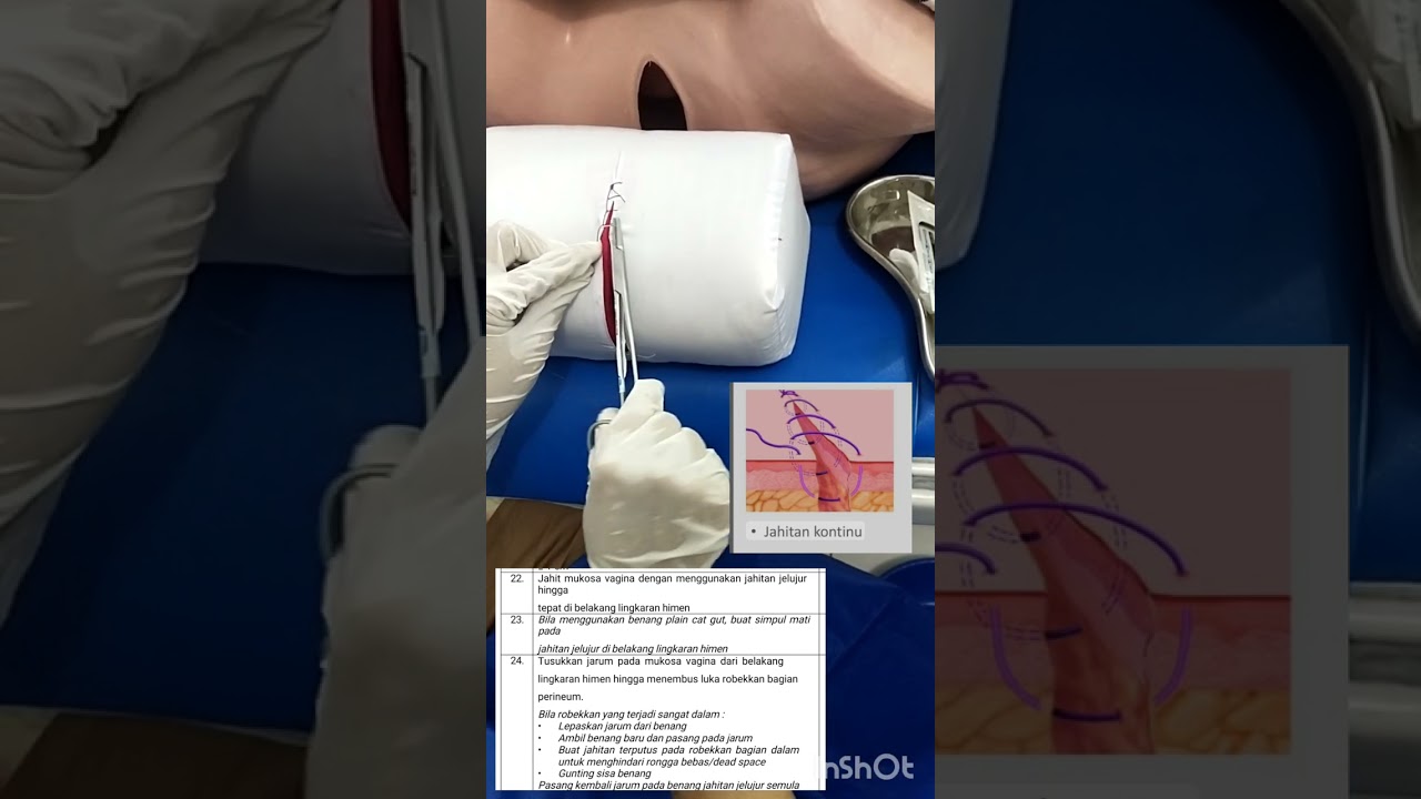 Penjahitan Laserasi Perineum