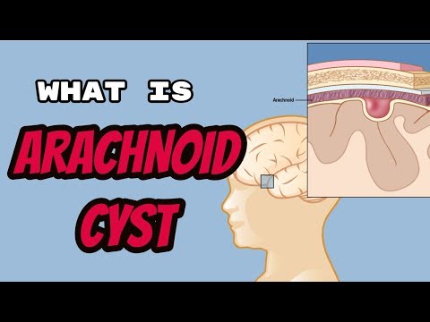 What is Arachnoid Cyst?